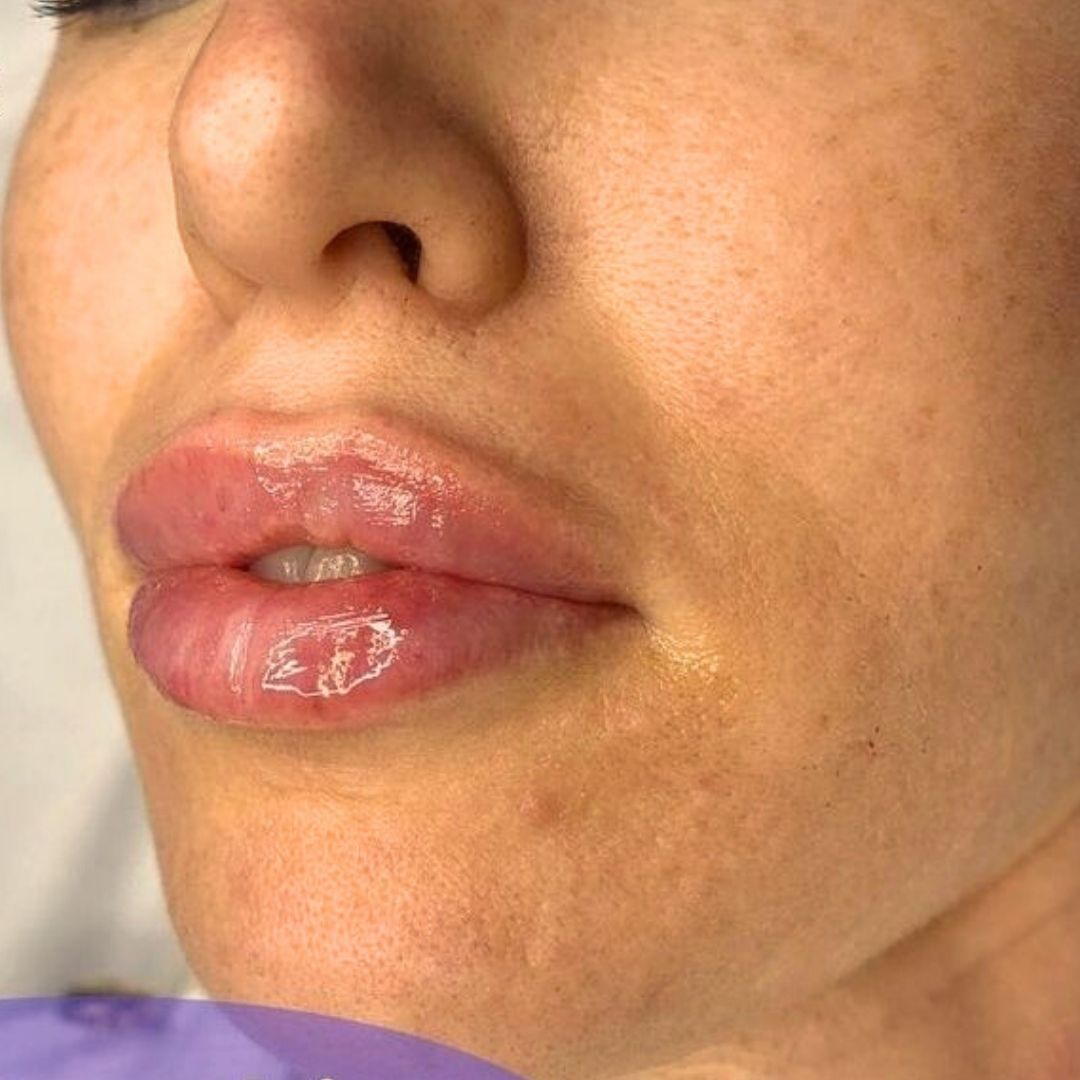 Filler Labbra